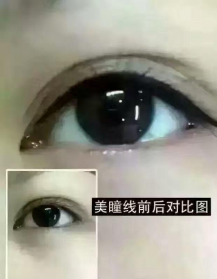 美瞳线是什么？什么样的人适合做美瞳线？